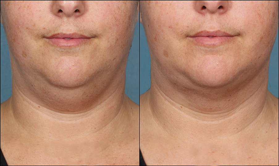 KybellaPatientPR5BeforeAfterFrontView_1