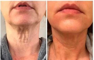 Resultados-do-endolaser-corporal-antes-e-depois-300x194