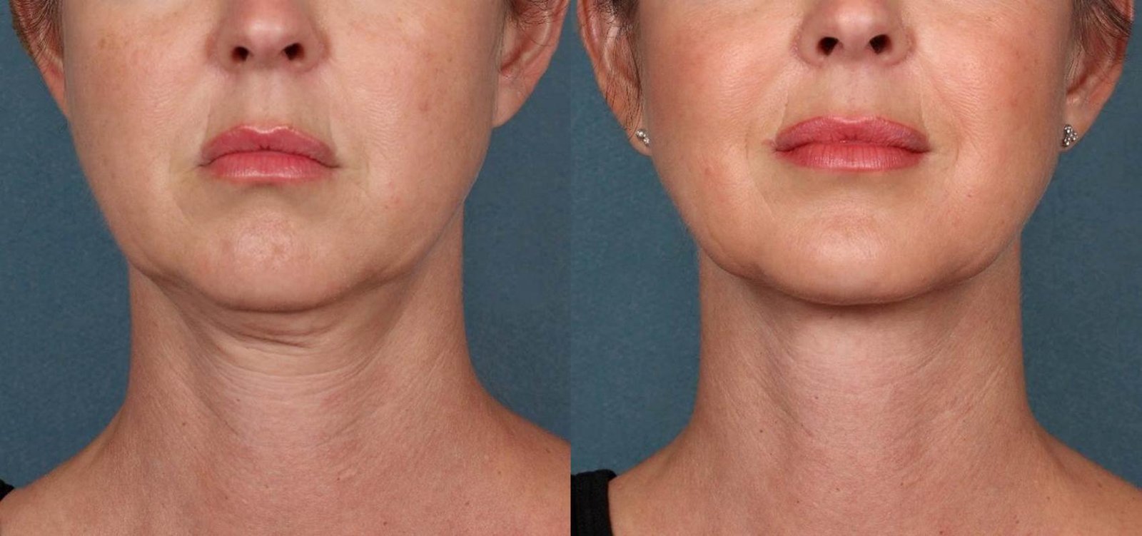 kybella-3-front-detail
